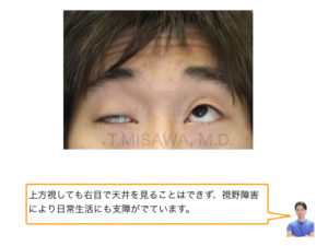 眼瞼下垂症の診断